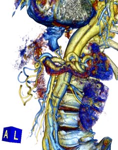 GPU Volume Ray Casting of two Volumes within VTK