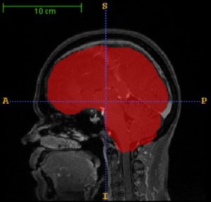 A Skull-Stripping Filter for ITK