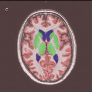 Fully automatic brain segmentation using model-guided level sets and skeleton-based models