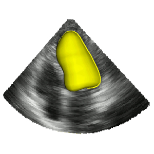 Automatized Evaluation of the Left Ventricular Ejection Fraction from Echocardiographic Images Using Graph Cut